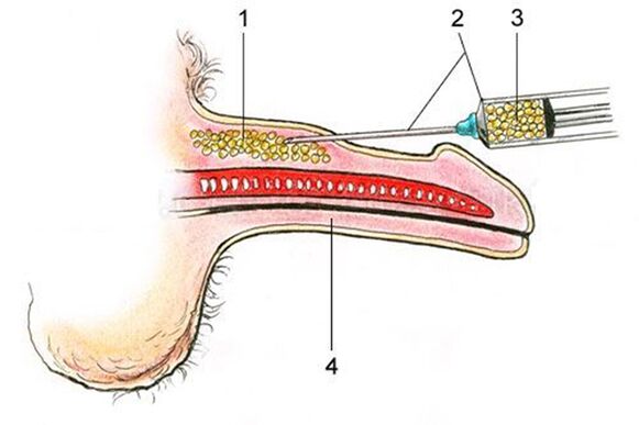 Lipofilling - insertion of fatty tissue into the shaft of the penis