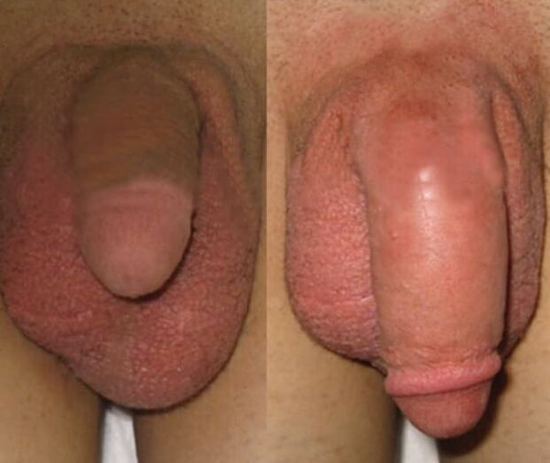 The result of collagen matrix installation in the penis