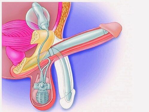 Penis enlargement through a penile prosthesis