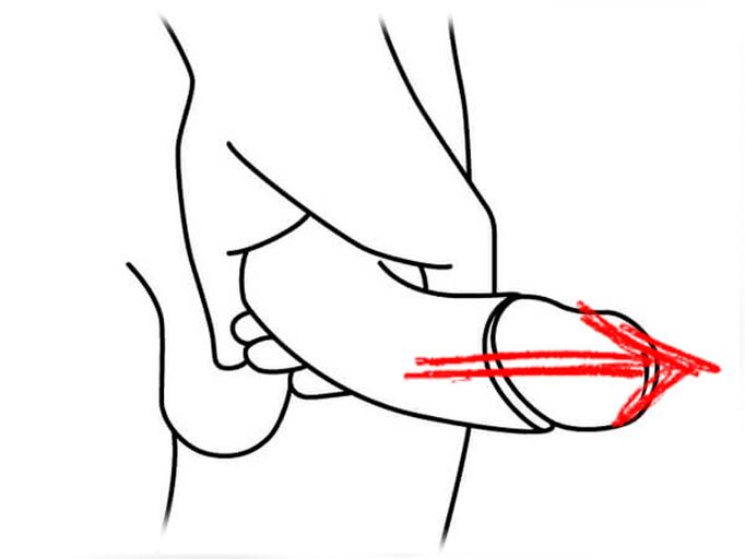 the prolongation of penis for expansion